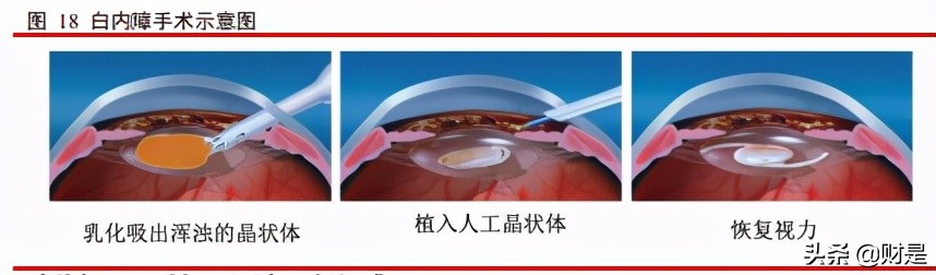 爱博医疗眼科器械上市,眼科行业研究报告