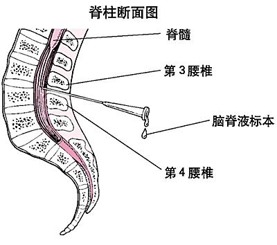 脑脊液检查结果都没事,脑脊液常规数值100