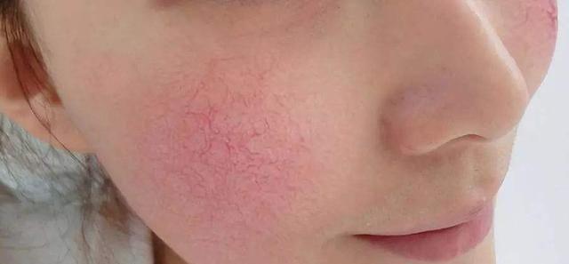 得了脚气到底会不会传染到其他部位？