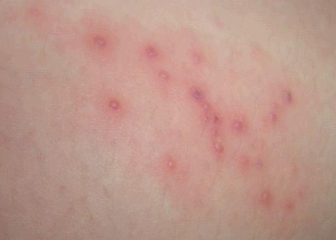 婴儿湿疹哺乳妈妈应少吃什么,湿疹可以少吃一点葱吗