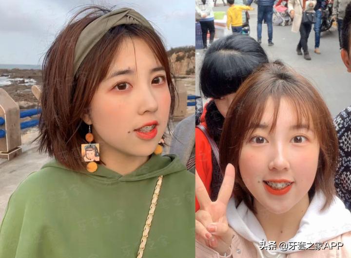 不靠整容怎么改变下巴后缩？看这里