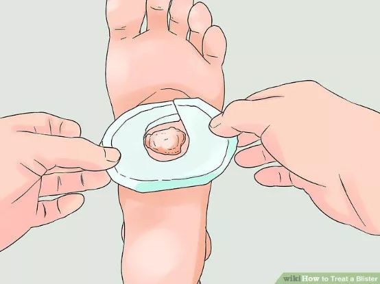 如何预防与处理比跑步膝痛还烦人的水泡？