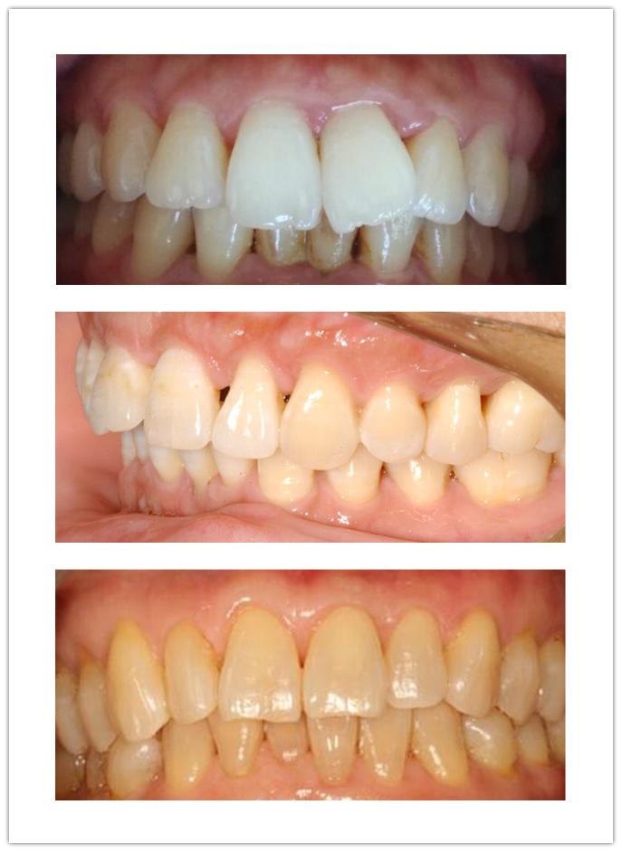 洗牙对牙齿有伤害吗能美白牙齿吗,洗牙美白的最快方法