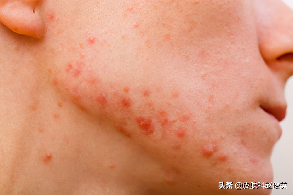 疮肿不能吃什么,什么病不能吃辛辣食物