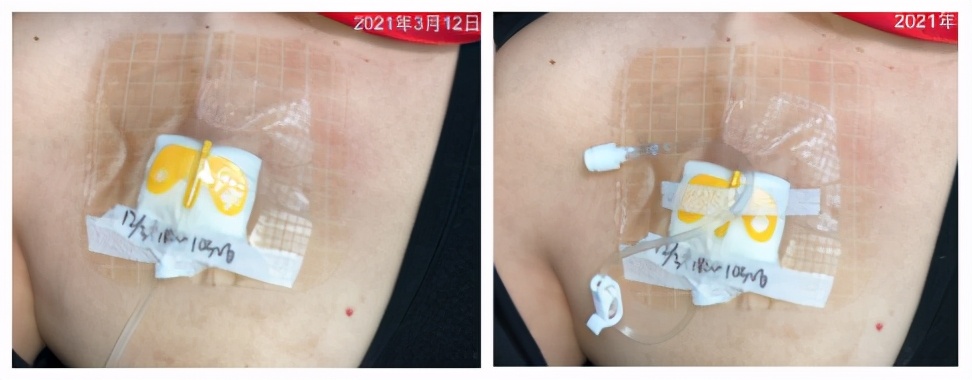 输液港皮肤过敏的处理,输液港输液有肿胀怎么处理