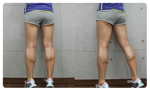 跑步一星期小腿粗了一圈怎么回事,跑步小腿肚子变粗怎么恢复