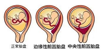 何为剖宫产术后子宫瘢痕妊娠,什么是剖宫产术后瘢痕憩室