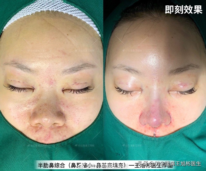 大鼻头缩小的改善原理,鼻头毛孔粗大如何改善缩小毛孔