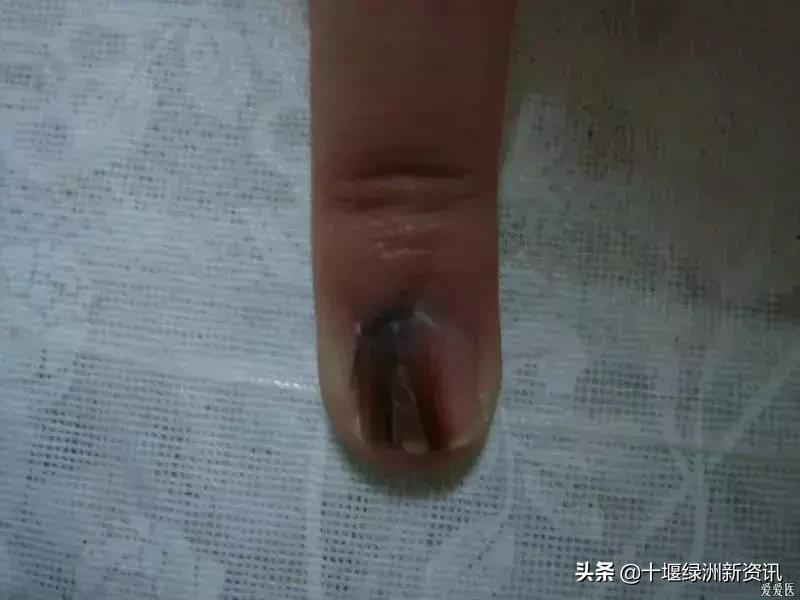 指甲上多出一条黑线没当回事，现在竟要截掉？