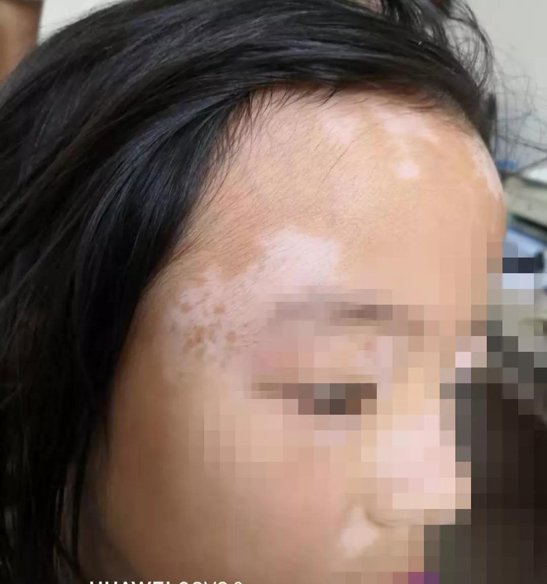 治疗白癜风中医好还是西医好,治疗白癜风中医好还是西医效果好