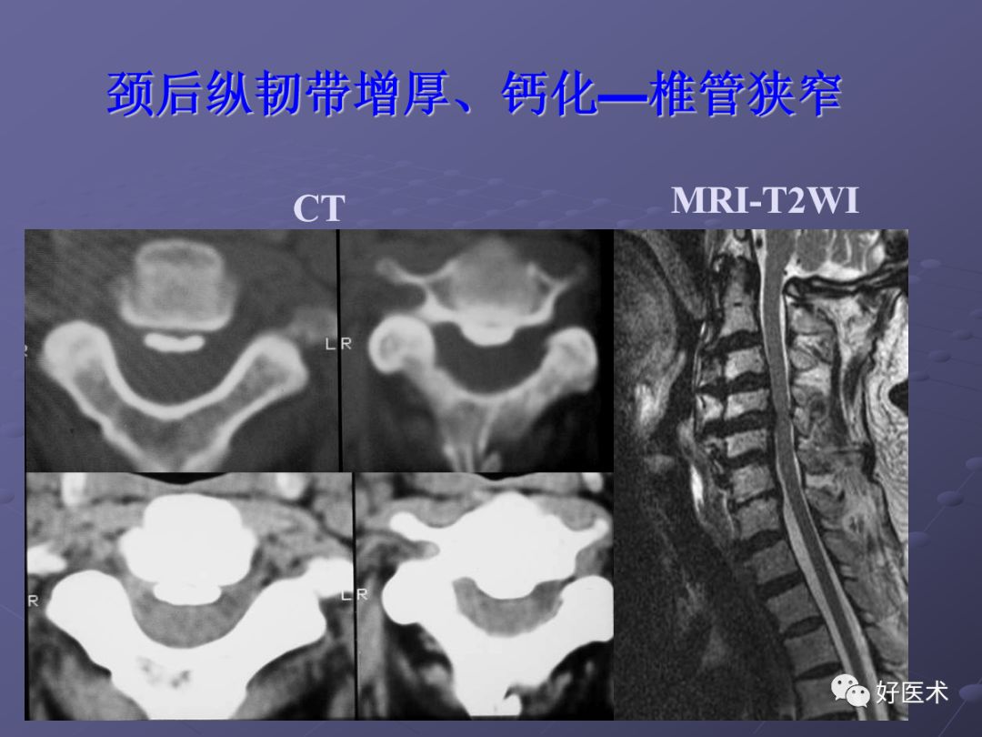 脊柱mri有哪些特点,乳腺疾病的mri诊断及鉴别