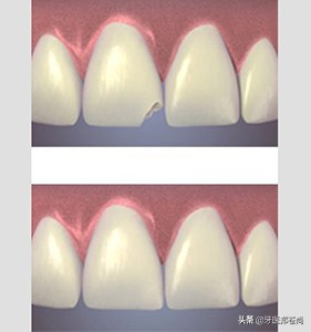 为什么做了烤瓷牙牙齿会疼,为什么做烤瓷牙往牙根里打钉子