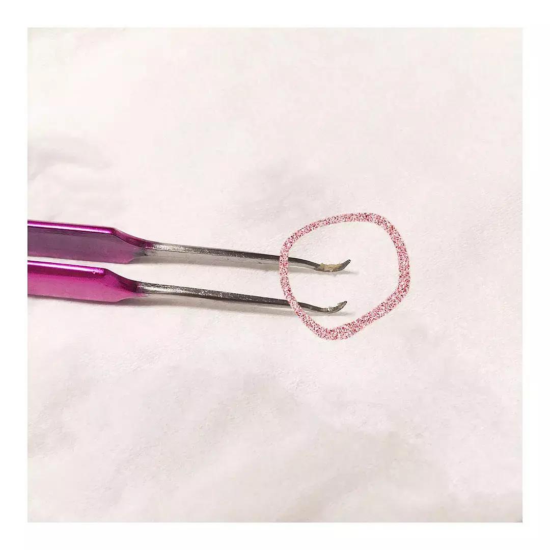 黑头可以用什么方法彻底清除,消除黑头简单有效的方法