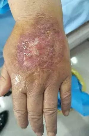 多柔比星渗到皮肤肿了咋办,多柔比星的注意事项