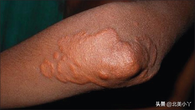 王医生谈血脂高怎么办,血脂防治小贴士