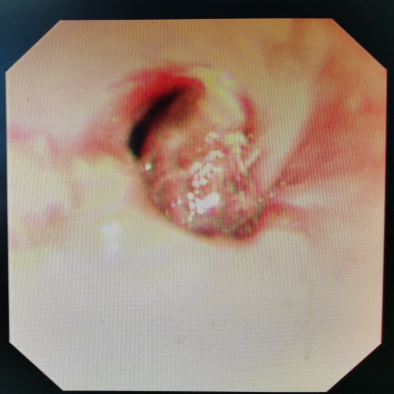 贲门癌吐血抢救,中国最著名的贲门癌治疗专家