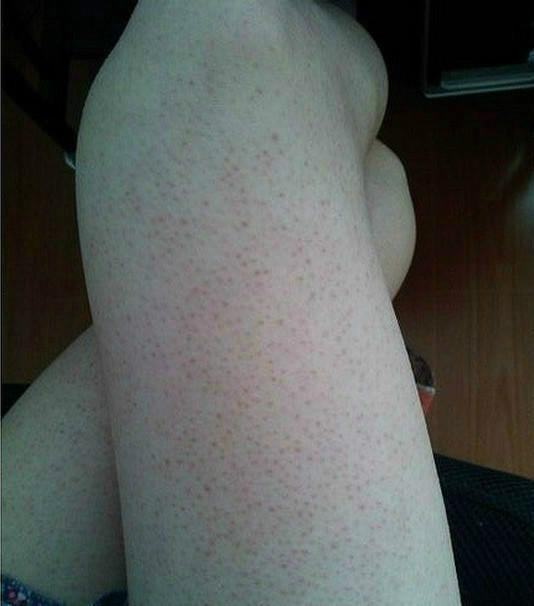 去除鸡皮肤最重要的三点