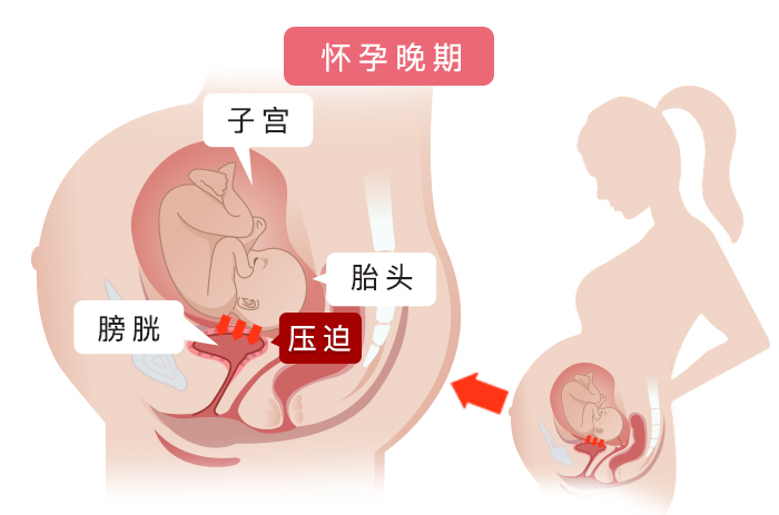 孕期尿频很难忍，憋尿是大忌，孕妇该怎么办？4招帮你轻松缓解