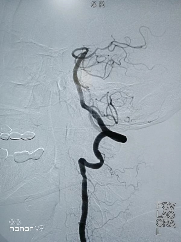 换瓣术后抗凝指南,换瓣术后抗凝不好有什么后果