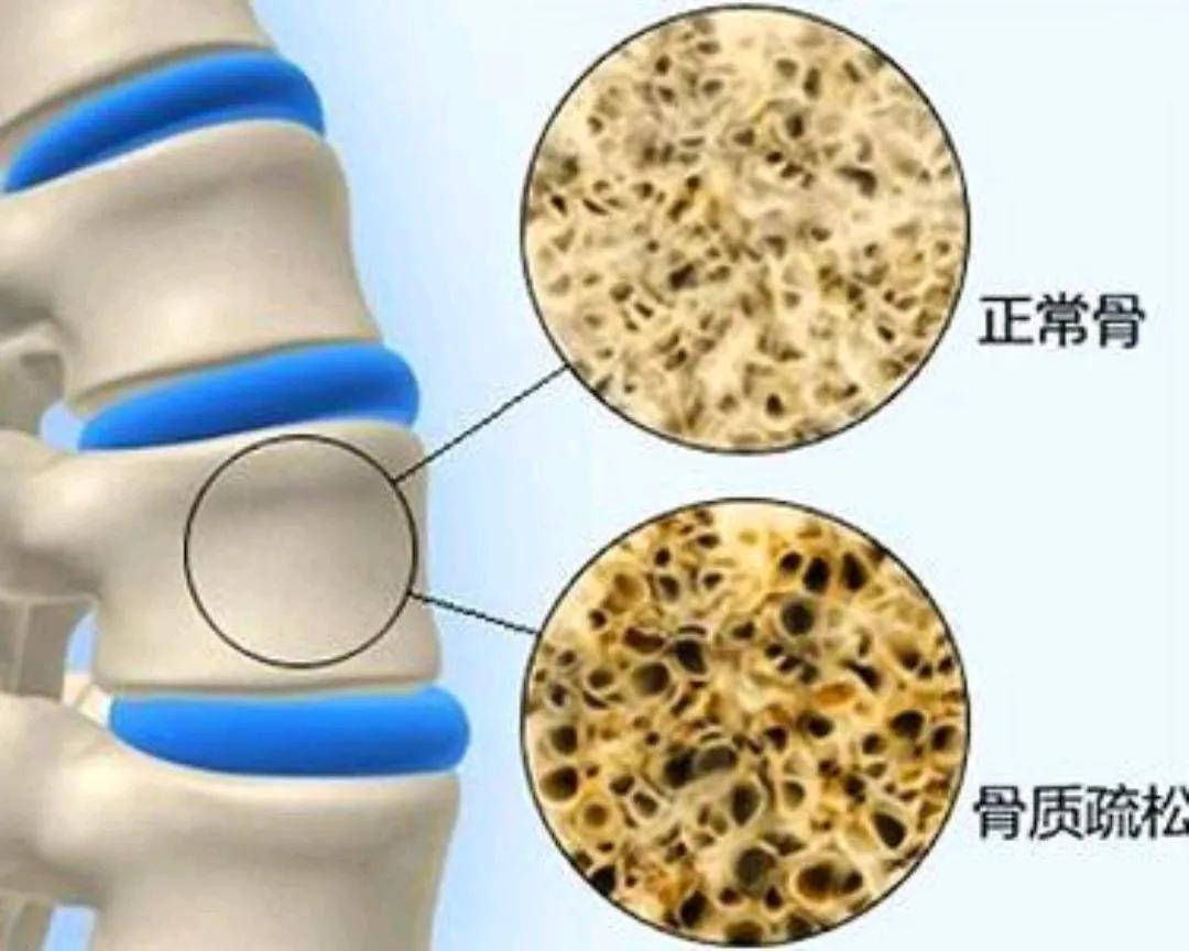 绝经情绪低落要怎么调理,女人绝经骨质疏松腰痛到底有多疼