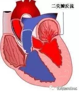 二尖瓣手术是微创还是开胸,二三尖瓣反流手术微创还是开胸