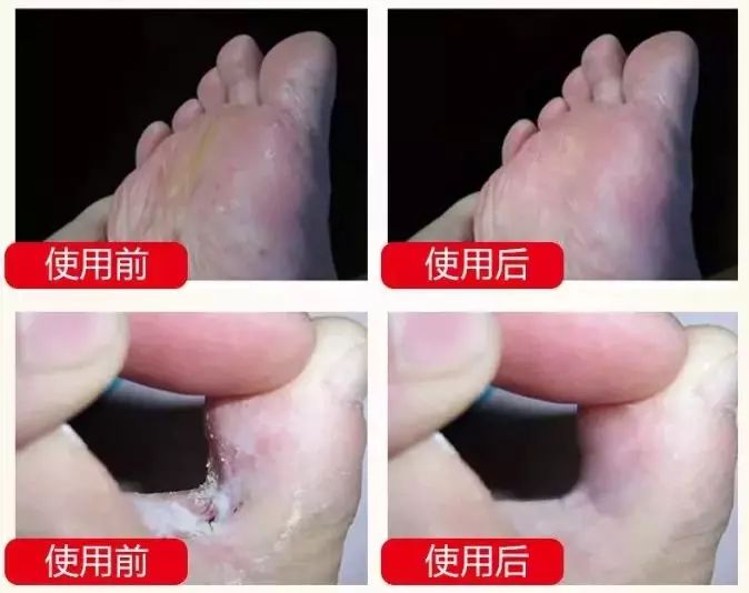 后脚跟干裂护足霜排行榜第一名,护脚霜脚后跟干裂修复霜国货