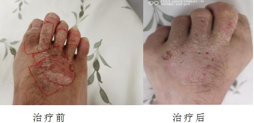 锶敷贴治疗血管瘤,90锶敷贴治疗血管瘤费用