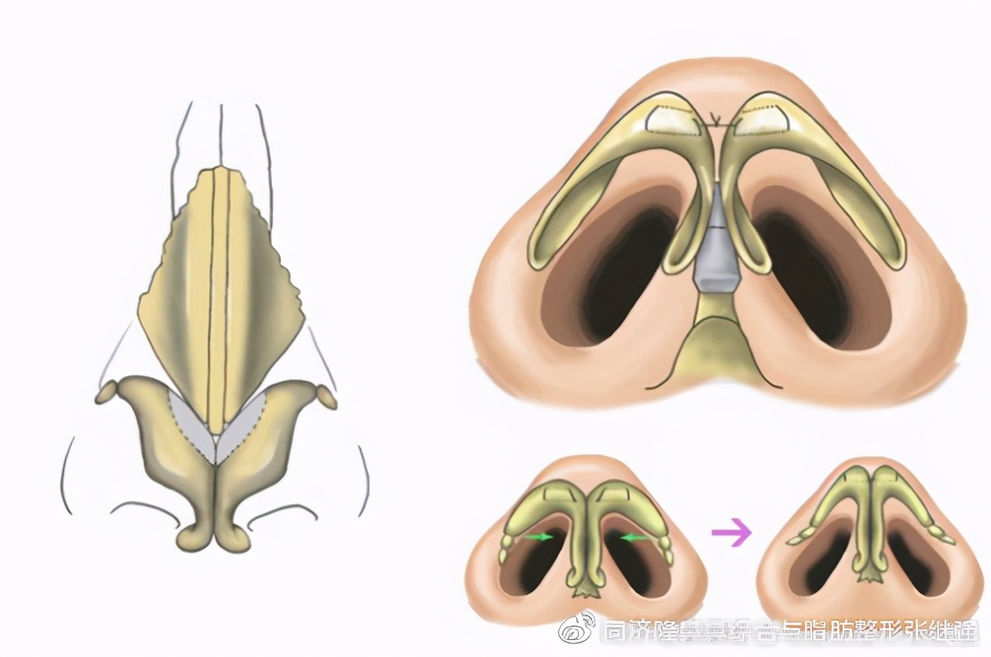 鼻头肥厚有哪些术式可以改善？