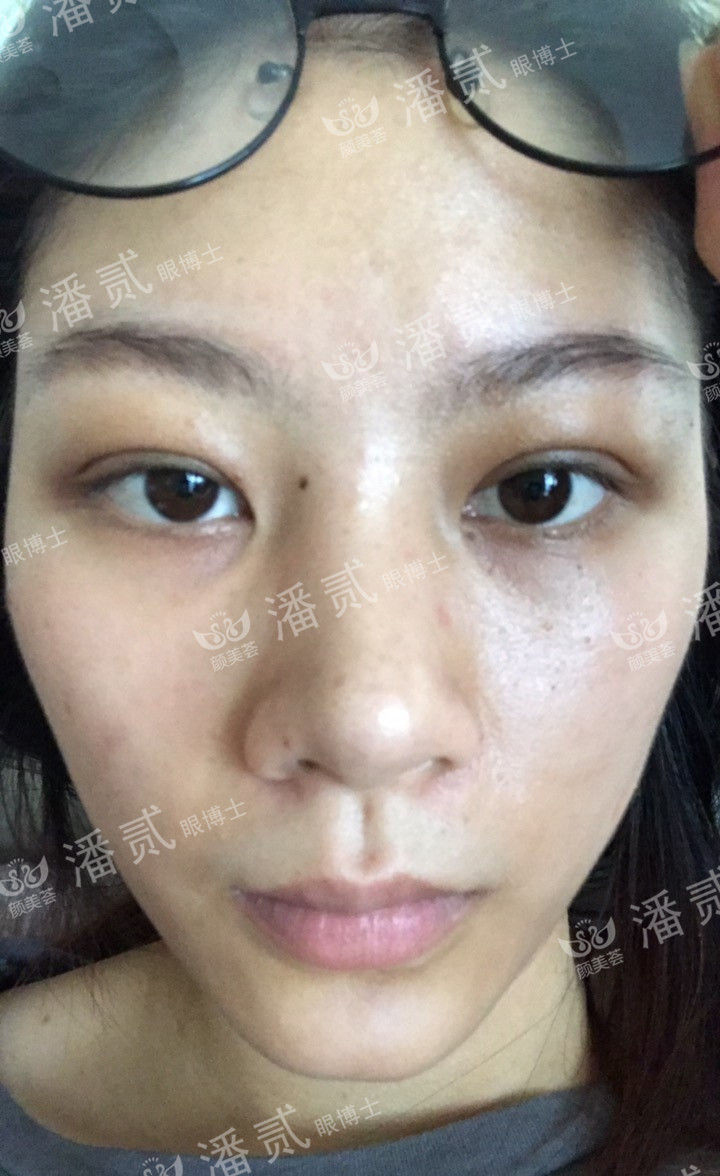 肿眼泡抽脂肪埋线双眼皮效果,肿眼泡割双眼皮长脂肪