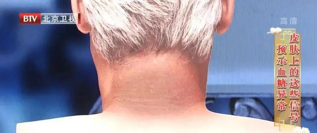 双下巴可不仅仅是胖，还有可能是疾病的信号！尤其是脖子粗过这个数的人，更危险