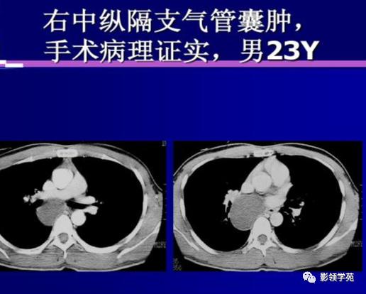 纵隔和肾上腺恶性肿瘤,纵隔性肿瘤位置图