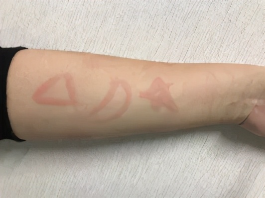 得了麻疹自己会好吗,得了荨麻疹会变成敏感肌吗