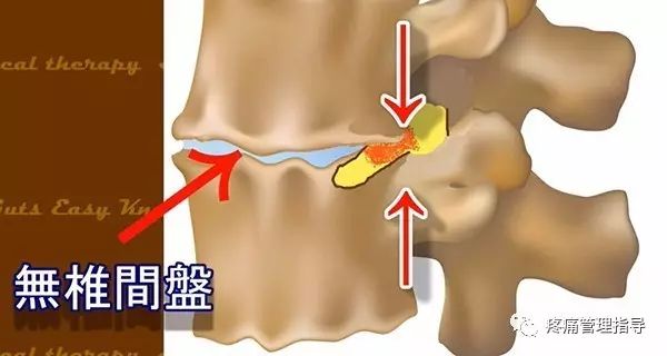 72岁老人腰疼还有骨刺该怎么治疗,老年人骨刺疼痛怎么治疗