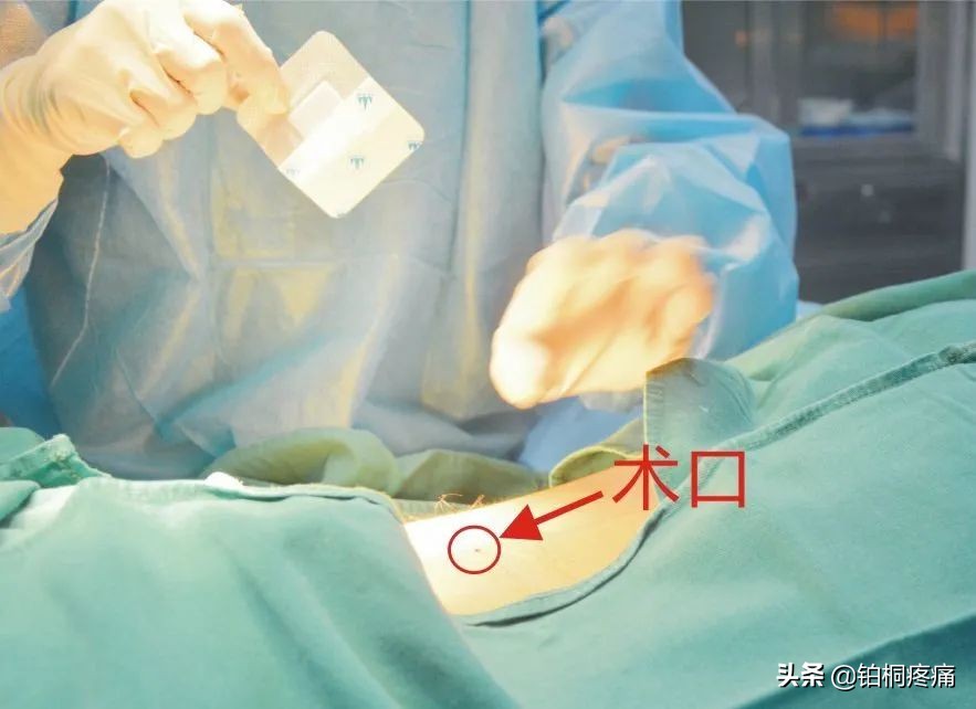 疼痛的小针刀治疗视频,疼痛科小针刀护理科普视频