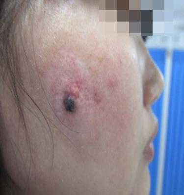 什么是晕痣和白癜风,晕痣型白癜风和白癜风有什么区别