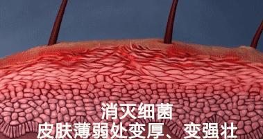 湿疹性皮炎最简单的自愈方法,全身都痒皮炎湿疹最好的治疗方法