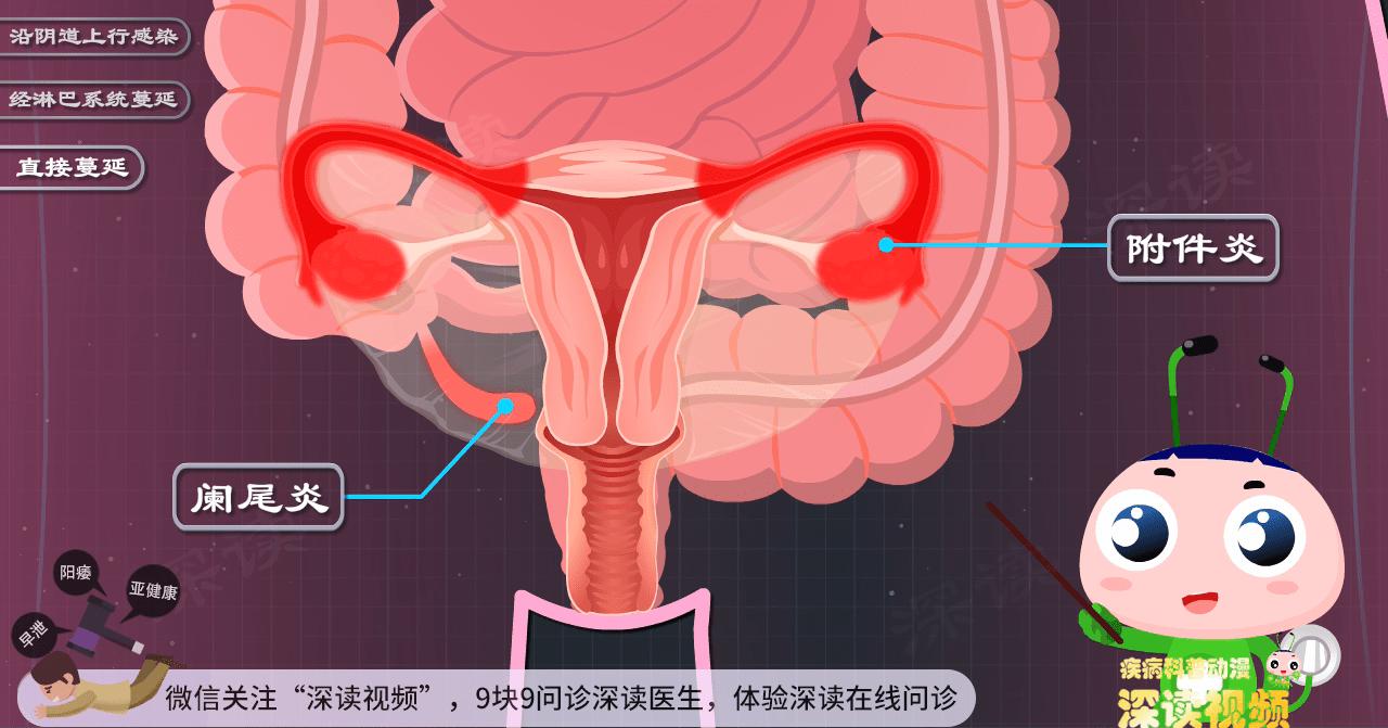 附件炎怎么造成的,人流后附件炎