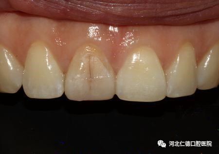 牙齿一咬硬东西就疼怎么回事,补过的牙齿咬了硬物痛起来怎么办