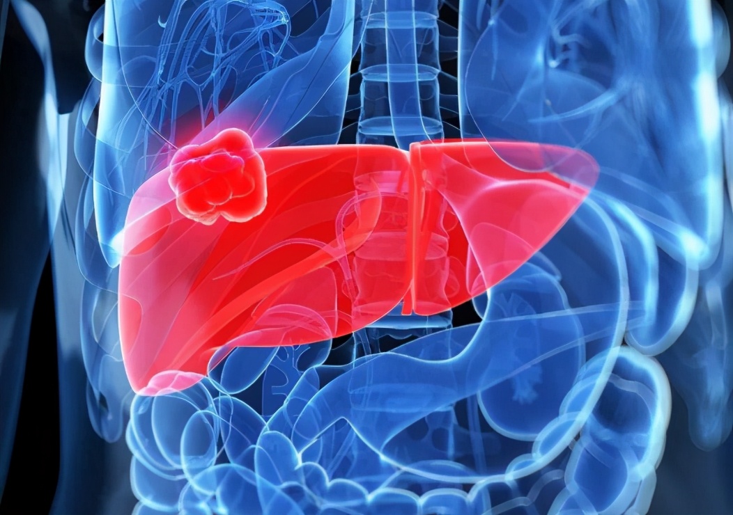 肿瘤标志物的甲胎蛋白偏高正常吗,肿瘤标志物查出甲胎蛋白偏高