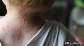 宝宝长水痘怎么处理好得快,小孩子水痘要是没发好会怎么样