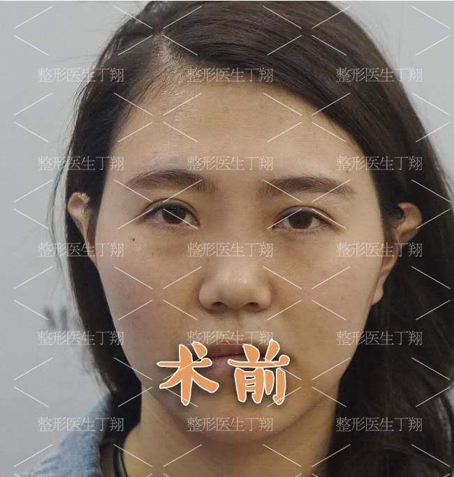 丁翔做隆鼻技术怎么样,美之峰丁翔