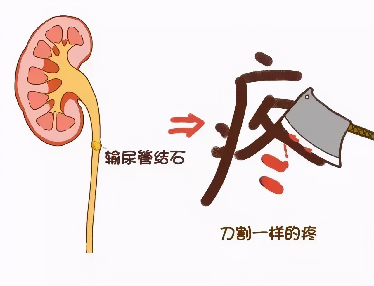 体外碎石后小腹疼痛恶心怎么回事,输尿管结石体外碎石后疼痛难忍