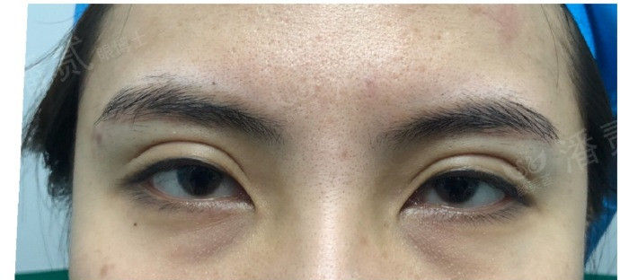 全切双眼皮提肌失败还能修复吗,什么是失败的双眼皮