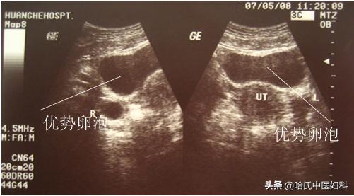 多囊卵巢综合症如何快速怀孕,多囊卵巢综合征怀孕了容易流产吗