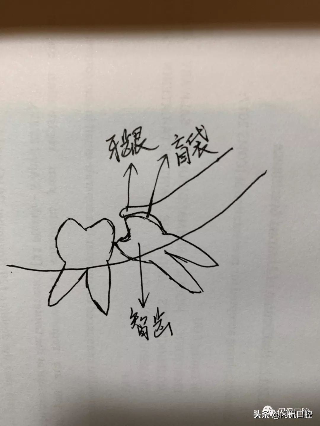 智齿发炎怎么办快速消肿止痛,智齿发炎怎么办最快最有效的方法