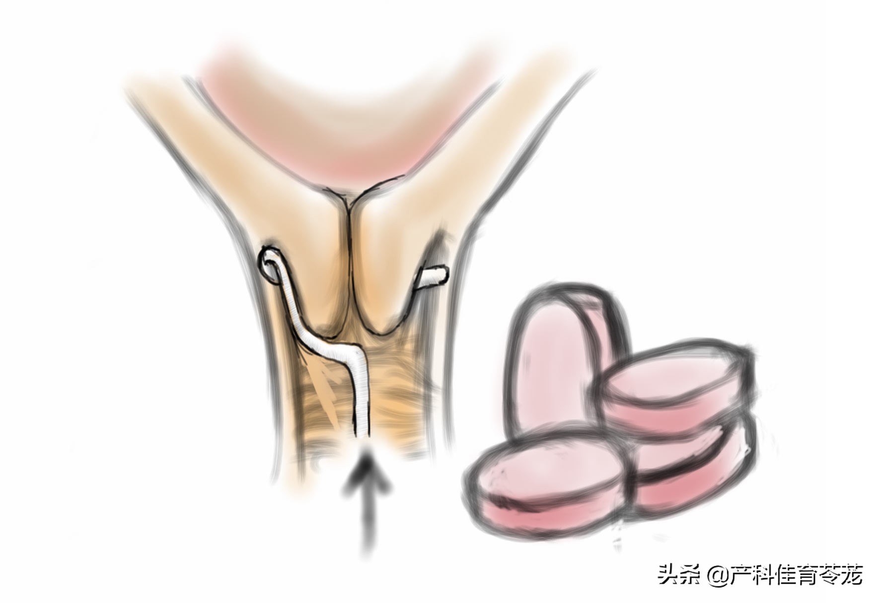 塞球囊好点还是打催产素好点,塞球囊和打催产素哪个生得快