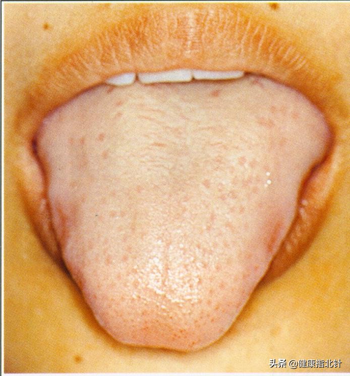 一招教你看舌苔6种舌苔你是哪种,身体好不好看嘴唇就知道了