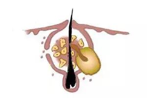 卸妆水可以去除鼻子上的黑头吗,鼻子上的黑头去除后怎么收缩毛孔