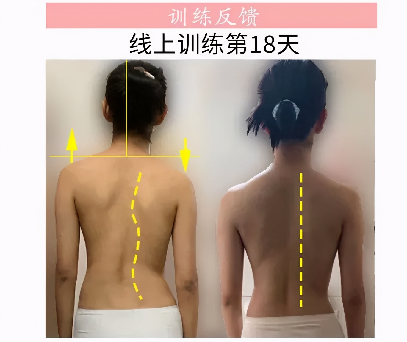 美背体态纠正,体态调整并开肩美背