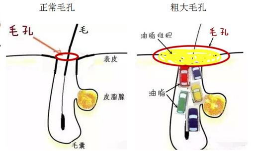 收缩毛孔10个最有效的方法,毛孔收缩真实有效的方法